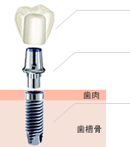 インプラントの構造