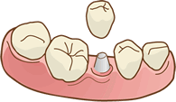 インプラントとは