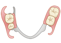 部分入れ歯 （部分義歯）