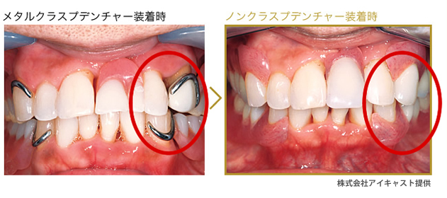 金属バネを使用しないノンクラスプデンチャー