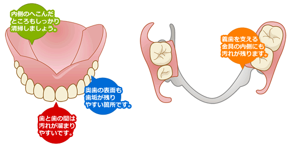 義歯（入れ歯）の清掃のポイント